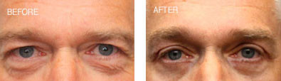 Upper and Lower Blepharoplasty with Endoscopic Brow Lift