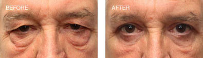Upper and Lower Lid Blepharoplasty