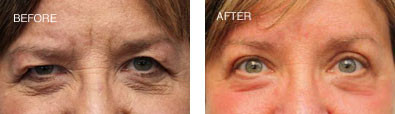 Upper and Lower Lid Blepharoplasty