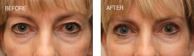 Upper Lid Blepharoplasty