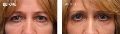 Upper Lid Blepharoplasty