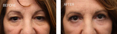 Upper and Lower Lid Blepharoplasty with lower lid CO2 Resurfacing