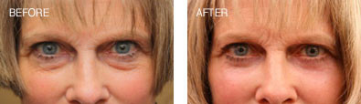 Lower Lid Blepharoplasty with lower lid CO2 Resurfacing
