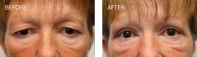 Upper Lid Blepharoplasty