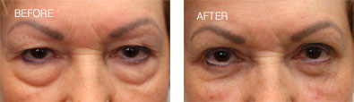Upper and Lower Lid Blepharoplasty