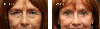 Upper and Lower Blepharoplasty with Endoscopic Brow Lift and CO2 Skin Resurfacing