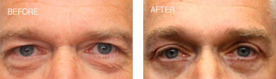 Endoscopic Brow Lift with Upper and Lower Blepharoplasty