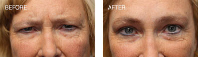 Endoscopic Brow Lift