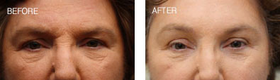 Endoscopic Brow Lift