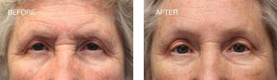 Endoscopic Brow Lift