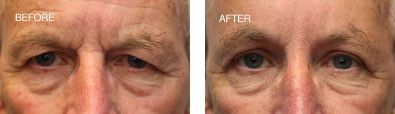 Endoscopic Brow Lift