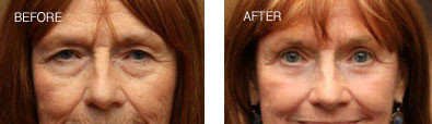 Upper and Lower Blepharoplasty with Endoscopic Brow Lift and CO2 Skin Resurfacing