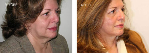 RejuvaLift™/Traditional Face Lift