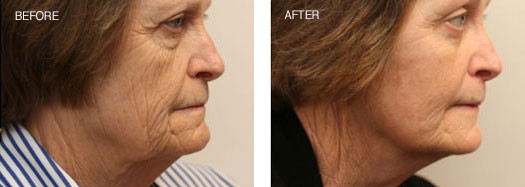 RejuvaLift™/Traditional Face Lift with Endoscopic Brow Lift and Upper and Lower Lid Blepharoplasty