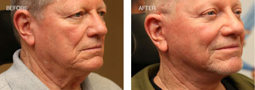 RejuvaLift™/Traditional Face Lift with Endoscopic Brow Lift and Upper Lid Blepharoplasty