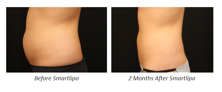 Smartlipo - Before and After