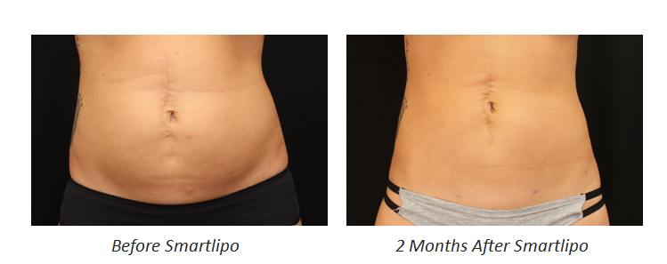 Smartlipo - Before and After