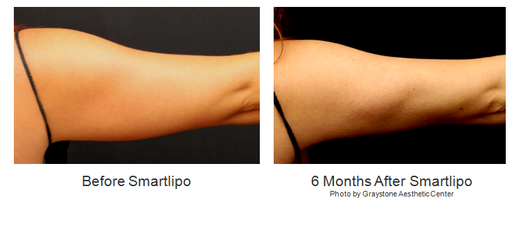 Smartlipo - Before and After