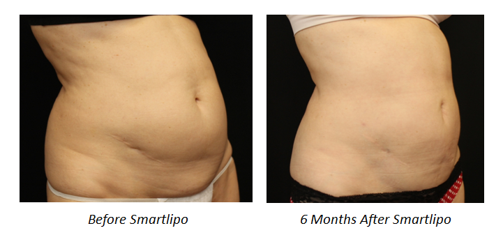 Smartlipo - Before and After