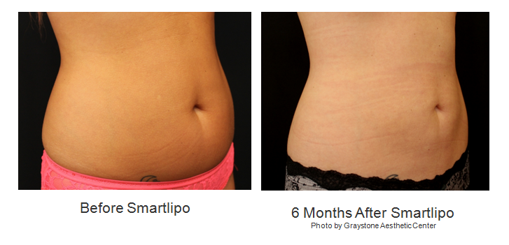 Smartlipo - Before and After