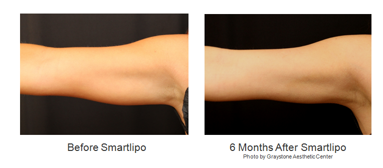 Smartlipo - Before and After